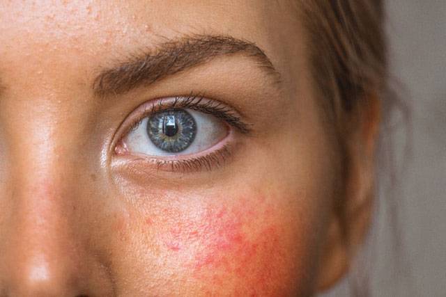 Critical Skin-Care Tips for Rosacea