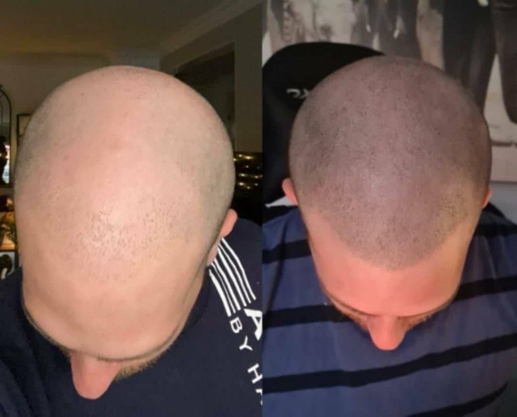 Scalp Micropigmentation - A Modern Approach for Curing Baldness!